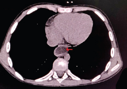 Arrow in the axial view of computed tomography of the chest showing dilated oesophagus.